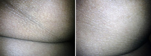 Figure 3 Low magnification  of dermascope view (10×). Before treatment, there were oblique skin folds on buttock with scale-4 depression (more than 2 mm) (left panel). Seven months after treatment, oblique skin folds, and the depression were improved (right panel).