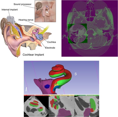 Figure 1 Top left: Cochlea and cochlear implant components. Top right: Fused cochlea image from CBCT, CT, and MR images. Bottom: Cochlear image segmentation of μCT showing the cochlea main scalae. Scala tympani in green and both scala vestibuli and scala media in red (top: 3D view: bottom from left to right: axial, sagittal, and coronal views).