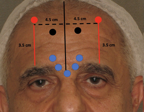 Figure 3 Injection points of OnabotulinumtoxinA on the glabellar complex and frontalis to maintain original eyebrow position. 4 units each in Procerus, Depressors supercilii and Corrugators supercilii. 2 points of 2 units each on Frontalis at 3.5 cm above the peak of the eyebrows. 2 points of 2 units each in mid-Frontalis for horizontal forehead line.
