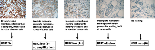 Figure 1 HER2-testing in primary male breast cancer.