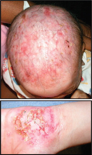 Figure 2. Clinical presentation of AEC patients. Scalp and palmar erosions on two patients affected by AEC. Patient images provided by the National Foundation for Ectodermal Dysplasias (NFED).