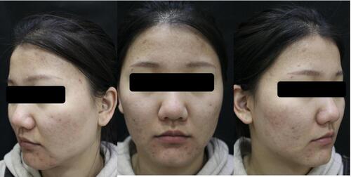 Figure 4 A female patient aged 20 of the observed group. Frontal and bilateral clinical photos of the face 6 months after treatment.