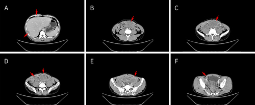 Figure 1 (A) Abdominal and pelvic CT scan reveals multiple nodules and masses present on the liver capsule (red arrow), (B) the largest lesion measuring approximately 87mm x 53mm and located in the mid-abdomen (red arrow), (C–F) there are also multiple nodules and mass lesions within the abdominal cavity (red arrow).