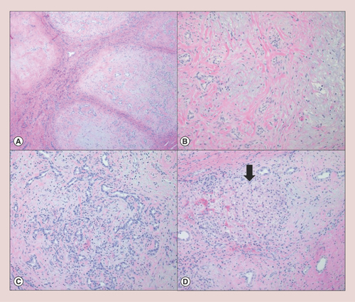 Figure 1. Pathologic findings of hepatic mesenchymal hamartoma.Hepatic mesenchymal hamartoma is histologically characterized by (A) a multinodular growth of myxomatous mesenchymal stroma with intervening fibrous septa (hematoxylin & eosin, 4×); (B) each nodule consists of a bland spindle cell proliferation with scattered malformed bile ducts (hematoxylin & eosin, 10×). (C) Some of the nodules demonstrate a florid bile duct proliferation with scattered lymphocytic infiltrate (hematoxylin & eosin, 10×). (D) Entrapped island of hepatocytes (arrow) is occasionally identified in the periphery of the lesion (hematoxylin & eosin, 10×).