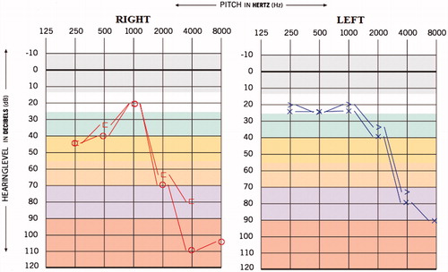 Figure 4. Post-medication audiogram of case 2.