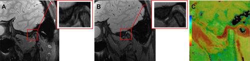 Figure 5 Disc displacement of temporomandibular joint without reduction in adolescents: closed-mouth position (A), open-mouth position (B), and T2 mapping image artifact (C).