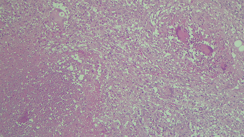 Figure 6 Microscopic examination revealing epithelioid granulomas of various shapes and sizes, necrosis, giant multinucleated cells (Langhans giant cells).