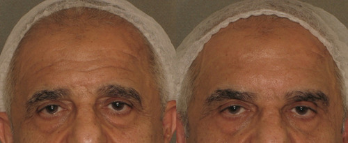 Figure 7 Before and after OnabotulinumtoxinA in a male patient.