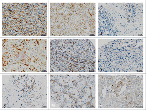 Figure 3. PD-L1, PD-1, CD3 and CD8 expression in high-grade sarcoma of soft tissue and tumor-infiltrating lymphocytes (TILs). 1 a)–1f) Representative examples of undifferentiated pleomorphic sarcoma (UPS) showing membraneous PD-L1 expression in tumor cells with (a) strong staining (3+), (b) intermediate staining (2+); c) UPS with PD-L1 positive TILs; d) UPS with double staining: red: PD-L1 positive lymphocytes, brown: CD163 positive histiocytes, intermingled negative TCs; (e) CD3+ TILs in high infiltration density; (f). UPS with scarce PD-1 positive TILs. 1 g)–1j) PD-L1 staining in representative high-grade sarcomas of soft tissue: (g) Epithelioid sarcoma, (e) Angiosarcoma, (f) Alveolar soft part sarcoma.