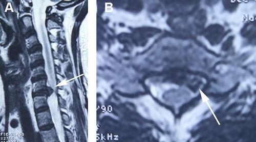 Figure 1 Preoperative MRI. Sagittal (A) and axial (B) MRI scans revealed a C6–C7 disc herniation resulting in compression of the left C-7 nerve root (arrow).