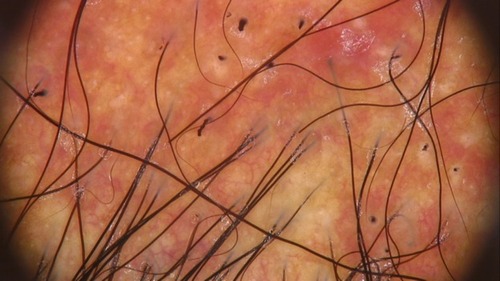 Figure 5 Active phase of the disease with red and milky areas, absence of follicular opening, and several hair shafts broken.