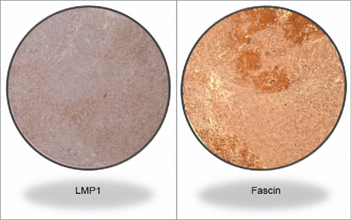 Figure 1B. LMP1 and Fascin co-expression in a high grade invasive CRC cancer sample (Magnification 100X).