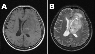 Figure 1 MR images show a huge mass with iso- and high-signal intensities on T1WI(A) and T2WI(B), respectively, involving the fronto-temporal lobe and the basal ganglia.