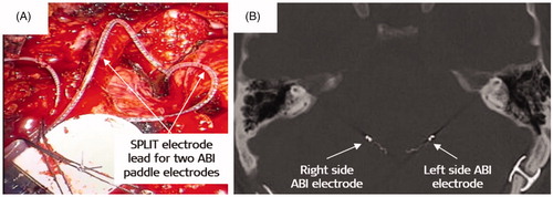 Figure 24. The surgical image of SPLIT ABI electrode showing two branches of electrode lead that goes into both Foraminae of Luschkae (A). Postoperative CT image showing the proper placement of ABI paddle electrodes bilaterally [Citation23].