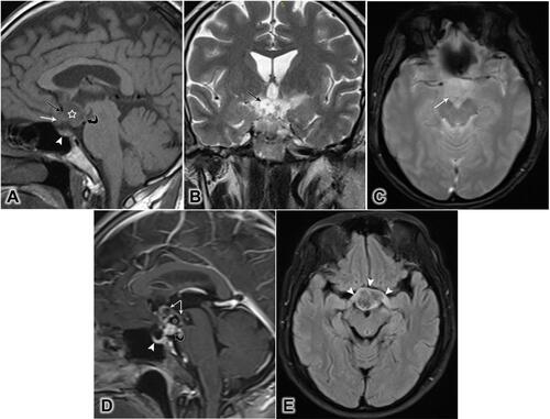 Figure 1 Brain MRI of a 50-year-old male patient, showing a lobulated contour mass with cystic and solid components. (A) Mid-sagittal T1-weighted image showing a hypointense lesion (star), expanding into the supraoptic recess (black arrow), bowing the floor of the third ventricle (curved arrow), and displacing the optic chiasm downward and forward (white arrow). The pituitary gland remains intact (white arrowhead). (B) Coronal T2-weighted image showing the cystic component (arrow). (C) Axial T2-weighted image showing no intratumoral calcification (arrow). (D) Sagittal T1-weighted post-contrast image showing rim enhancement (white arrows) of the cystic component (star), a strongly heterogeneous solid component (black curved arrow), and the normal enhancement of the pituitary gland (arrowhead). (E) Axial fluid-attenuated inversion recovery (FLAIR) showing the anterior deviation and edema of the optic chiasm (arrowheads).