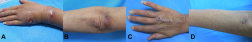 Figure 1 Swelling and purulent exudation from the wrist (A) to the left forearm (B); beaded proliferative nodules from the dorsum of the right hand (C) to the right forearm (D).