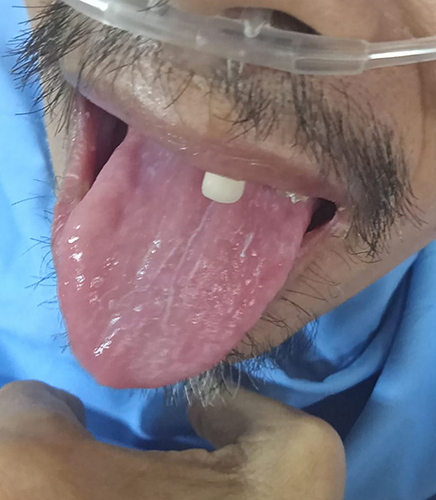 Figure 3 White plaque covering the intraoral mucosa and the surface of the tongue is getting thinner.