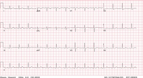 Figure 3 Electrocardiogram showing normal sinus rhythm.