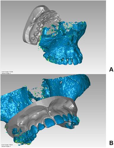 Figure 3 STL files of CBCT and dental arches. (A) before alignment. (B) After alignment.