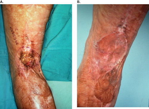 Figure 2. (A) Burn scar SCC in the popliteal area; (B) following excision and skin grafting. Unfortunately a new lesion developed at the ipsilateral upper thigh 8 years later.
