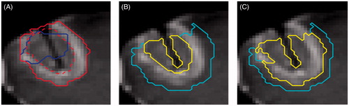 Figure 1. Tumour/thermal lesion segmentations and predicted regions. The segmented tumour (blue) and the thermal lesion defined by the central non-enhancing region (red dotted) and enhancing ring (red solid) with skull-stripped post-treatment post-contrast image in the background (A). The regions classified as y = 1 (yellow) and y = 0 (cyan) for the inner boundary (B), outer boundary (C) predictions with skull-stripped post-treatment post-contrast image in the background. The area adjacent to the skull has been excluded due to uncertainty in the segmentation and the area of ambiguous enhancement was excluded in the outer boundary model (C).