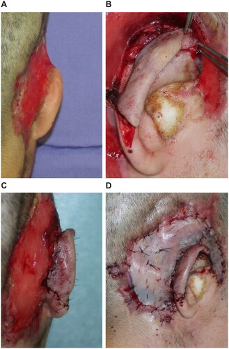 Figure 5. Reconstructive surgery, 66 days after. (A) Preoperatively, the auriculotemporal sulcus has disappeared. (B) VY advancement flap in the auricle. (C) The auriculotemporal sulcus is created. (D) Skin grafting on the temporal area.