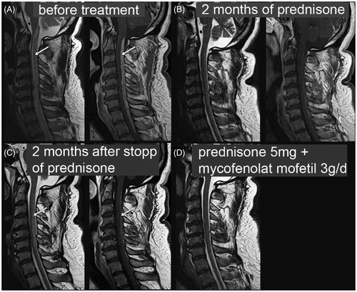 Figure 10. Spinal cord neurosarcoidosis treatment response to prednisone and mycophenolate mofetil. T2-weighted (left) and T1-weighted post-contrast images (right) of the cervical spinal cord in a 51-year-old patient with neurosarcoidosis and a tetraparesis below cervical C3 level. A: Before treatment. Arrows point to T2 hyperintensity and T1 contrast enhancement in cervical spinal cord, spreading over multiple cervical segments. B: Dramatic improvement after pulsed steroid treatment slowly tapered off. C: Relapse with clinical and imaging correlate (arrows) 2 months after complete discontinuation of prednisone. D: Clinical and imaging findings are improved under mycophenolate mofetil 3 g/d + 5 mg prednisone (no T1 post-contrast image available at that time point). Courtesy of Dr A. Rosskopf, Balgrist.