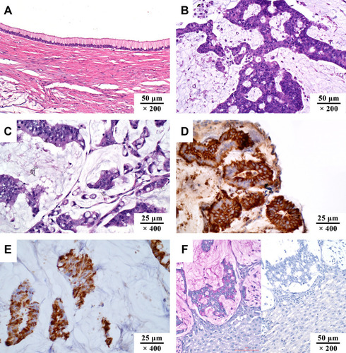 Figure 1 The pathological manifestations of pseudomyxoma peritonei. (A) low-grade mucinous carcinoma peritonei (HE, ×200); (B) high-grade mucinous carcinoma peritonei (HE, ×200); (C) high-grade mucinous carcinoma peritonei with signet ring cells (HE, ×400); (D) MUC2 positive (IHC, ×400; MUC2, clone MRQ-18, catalog number ZM-0392); (E) MUC5AC positive (IHC, ×400; MUC5AC, clone MRQ-19, catalog number ZM-0395); (F) PAS staining of mucus, pink area in the left image (HE, ×200). The staining turned negative when incubated with salivary amylase. Unpublished data from the authors’ group.