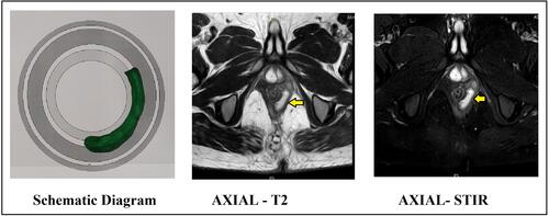 Figure 3 Abscess in left intersphincteric space from 3 to 6 o’clock. (external sphincter muscle can be seen lateral to the abscess). Abscess indicated by yellow arrows. Left panel: Schematic diagram. Middle panel: MRI axial section T-2 sequence. Right panel: MRI axial section STIR (Short T-1 Inversion Recovery) sequence.