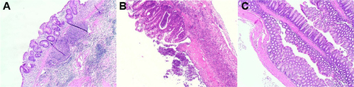 Figure S4 Histology images of dextran sodium sulfate-treated (A, B) and healthy (C) mouse colonic mucosa.Notes: Colonic segments, fixed in 4% formaldehyde, were stained with hematoxylin and eosin and reviewed by a pathologist in a blinded fashion. Original magnification for histology, 40×.