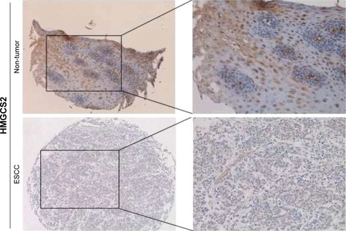Figure 2 Representative of HMGCS2 expression in adjacent non-tumor tissue (upper) and ESCC tumor tissue (bottom) detected by immunostaining with anti-HMGCS2 antibody (brown). The slide was counterstained was hematoxylin (original magnification: left ×100, right ×200).