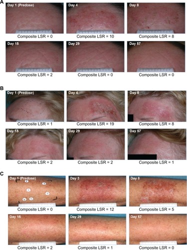 Figure 5 Clinical photographs of three patients. Photographs were taken at screening, before treatment on day 1, and on days 3 or 4 (one day after last treatment), 8, 15, 29, and 57. The composite local skin reaction score was calculated at each visit. (A) Forehead lesions. Intermediate peak composite local skin reaction score (10) on day 4 returned to baseline by day 29. (B) Forehead lesions. High peak composite local skin reaction score (19) on day 4 returned to baseline by day 57. (C) Arm lesions. Intermediate peak composite local skin reaction score (12) on day 3 returned to baseline by day 57.Data on file. Clinical study reports PEP005-016 and PEP005-028. Parsippany, NJ: LEO Pharma Inc.; 2010.