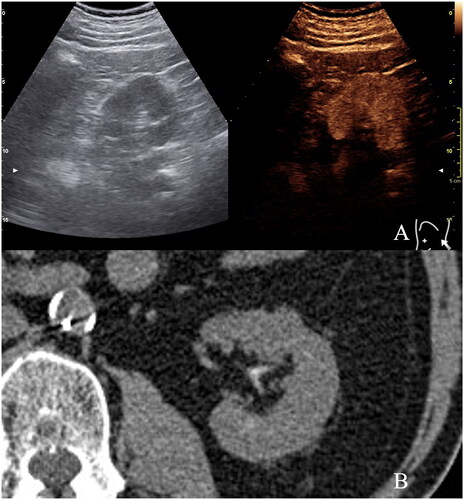 Figure 1. (A) Patient #1 preoperative US, completed by contrast administration. The renal tumor of the left kidney is hard to depict. (B) Unenhanced, left kidney CT: the borders of the intraparenchymal nodule are impossible to identify, as well as the full dimensions. Notes: US: ultrasound; CT: computed tomography.