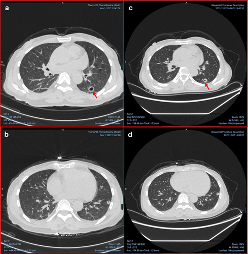 Figure 1 CT scan on admission (a and b) and 1 month later (c and d). (a and b) Chest computed tomography image taken in admission showing patchy, nodular, and flocculent ground-glass density shadows in each lobe of both lungs, nodules and cavities in the dorsal segment of the left lower lobe (red arrow). (c and d) Chest computed tomography image taken in 1 month later showing improvement in both lung lesions.