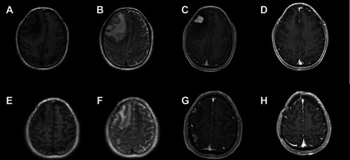 Figure 1 Magnetic resonance imaging (MRI) images of the two sporadic multiple meningiomas in a 52-year-old male patient. (A-C) Preoperative MRI showed a right frontal tumor with strong homogenous contrast enhancement, marked perifocal edema, and significant midline shift. (E-G) Preoperative MRI showed another well-demarcated and homogenously enhancing tumor at the right parietal convexity, but with minimal perifocal edema. (D, H) Follow-up MRI scan performed 8 months later confirmed the complete removal of both tumors.