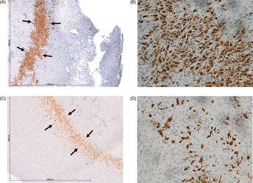 Figure 5. Effect of liposomal quercetin-RF on apoptosis at 4 h. Tumour tissue from liposomal quercetin-RF (A, B) stained for cleaved caspase-3 demonstrates a thicker band of staining (black arrows) at the periphery of the ablation zone with a greater percentage of positive staining cells compared to RF alone (C, D), noting a marked increase in apoptotic activity at 4 h (A, C = 4×; B, D = 40×).