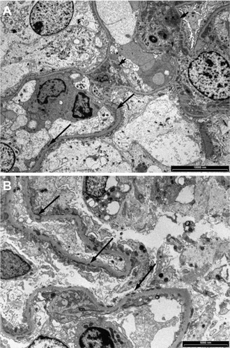 Figure 5 Granular electron dense deposits in Class MB lupus nephritis. (A) in the mesangium (short arrows) and (B) in the capillary basement membrane loops (long arrows).