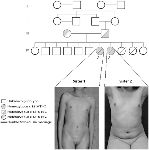 Figure 1. Genogram and physical traits of the two sisters with 17OHD. The sisters’ progenitors and their siblings are apparently healthy, except for two infant sisters, who died from unknown causes. Not all the members are represented in the genogram in order to illustrate the consanguinity and allele inheritance of the patients. Both patients showed absence of breast development and axillary or pubic hair. Their clitoral index did not show clitoromegaly.