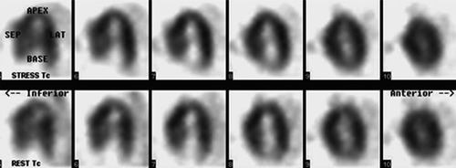 Figure 4 Myocardial perfusion imaging with 99mTc-MIBI – long horizontal axis view. No signs of ischemia or scar during dipyridamole-induced stress were noted.