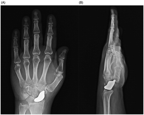 Figure 6. (A,B) At 1-year follow-up, radiography showed a correct radioscaphoid angle, with no scapholunate gap and good reconstruction of Gilula Arcs with entire near-to-normal carpal anatomy.