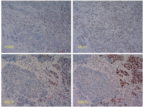 Figure 2 Immunohistochemistry of the MMR proteins. The tumor cells were assessed for expression of PMS2, MLH1, MSH2, and MSH6. The cancer nests in the bottom left are negative for MMR proteins, while those in the top right are all positive.Abbreviation: MMR, mismatch repair.