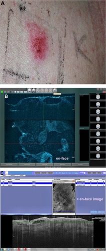 Figure 1 A positive patch test reaction (A) Skintell (B) VivoSight and (C) OCT images displaying intraepidermal signal-poor cavities that correspond to vesiculation.