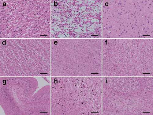 Figure 3. Representative microscopic findings of haematoxylin and eosin-stained specimens. (a) The neuropil shows severe rarefaction, and severe neuronal loss with fibrous gliosis is recognized. Achromatic neurons (inflated neurons) are scattered. Hypertrophic astrocytosis is apparent, and many macrophages are recognized (superior temporal gyrus). (b) Characteristic large cystic cavitation is observed. Macrophages are recognized in the cavities. Hypertrophic astrocytosis is no longer remarkable (parastriate area). (c) Mild vacuolization without apparent gliosis is observed in the subiculum. (d) The putamen shows severe rarefaction and severe neuronal loss with fibrous gliosis. (e) The globus pallidus is relatively preserved with very mild spongiform changes and gliosis. (f) The cerebral white matter shows tissue rarefaction, numerous foamy macrophages, and hypertrophic astrocytosis (occipital lobe). (g) The cerebellar molecular layer shows severe atrophy, and the granule cell layer shows severe neuronal loss, whereas the Purkinje cell layer is relatively preserved from neuronal loss. (h) The substantia nigra shows moderate neuronal loss with gliosis and severe tissue rarefaction. (i) The pontine nucleus shows severe neuronal loss with gliosis. The longitudinal pontine fasciculus shows numerous macrophages. Scale bars: a-c: 100 μm; d-i: 200 μm