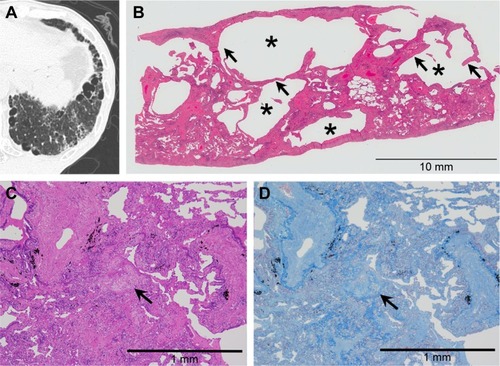 Figure 6 Combined SRIF and UIP patterns on thin-section CT images and histological findings.Notes: (A) Thin-section CT images showing foci of clustered cysts of irregular size and shape and surrounding ground-glass attenuation with reticular or branching structures. (B) This low-power photograph of the histological section (hematoxylin–eosin stain) reveals areas with irregularly shaped emphysematous spaces (asterisk) and hyalinized fibrotic walls (arrow). (C) High-power photograph of a histological section. Note dense fibrosis and fibroblastic foci (arrow) in the same histological specimen. (D) Masson’s trichrome stain reveals architecture destruction with irregularly distributed dense fibrosis. The fibroblastic focus (arrow) is seen inside the fibrosis.Abbreviations: SRIF, smoking-related interstitial fibrosis; UIP, usual interstitial pneumonia; CT, computed tomography.