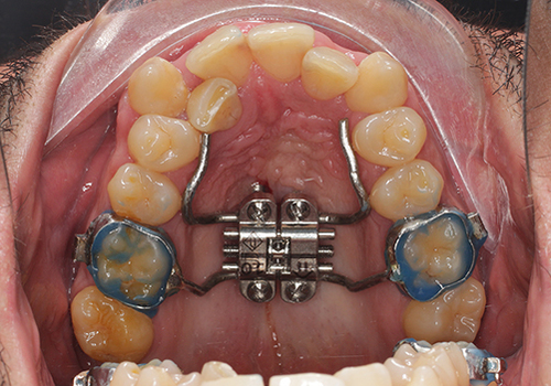 Figure 1 MARPE (microimplant assisted rapid palatal expansion).