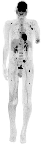 Figure 7. PET-SCAN 6 months after surgery showing sub-diaphragmatic, small intestinal and multifocal bone lesions. There was no recurrence on the upper-limb.