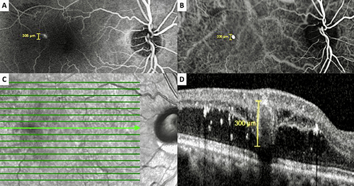 Figure 2 Case 5, Right eye of a 64-year-old otherwise healthy male. Late venous phase of the fluorescein angiogram (A) and indocyanine green angiogram (B) showing the well-defined roundish hyperfluorescent lesion. Reflectance image (C) depicts the well-defined round lesion with surrounding brighter hyporeflectant areas indicating the retinal edema. Horizontal spectral domain optical coherence tomographic section passing through the lesion (D) demonstrating the hyperreflective wall with a hyporeflective intraluminal material together with the intraretinal fluid and hyperreflective dots.