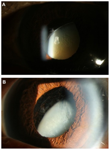 Figure 1 (A) Slit lamp photograph of the left eye with anterior subcapsular vacuolar changes in a subluxed cataractous crystalline lens. (B) Slit lamp photograph of the left eye with subluxed crystalline lens and vitreous prolapse into the anterior chamber.