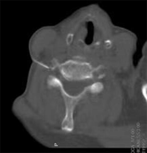 Figure 4 First step we try to put the tip to the target of anterior nodule of the foramina, vertebral artery showed at the same plane.