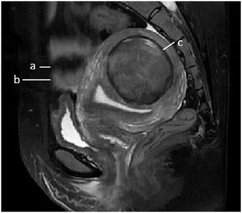 Figure 1. Sagittal view of MRI from a patient with uterine fibroid showed subcutaneous fat thickness (a); abdominal wall thickness (b); distance from the posterior surface of fibroid to the sacrococcyx (c).